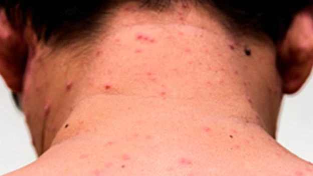 El Ministerio de Salud advirtió por una posible vuelta del sarampión