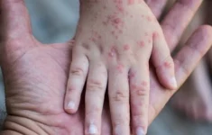 Viruela del mono: cuáles son los grupos con mayor riesgo de contagio y quiénes están protegidos ante la enfermedad